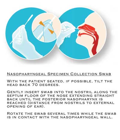 Nasopharyngeal specimen collection using sterile flocked swabs